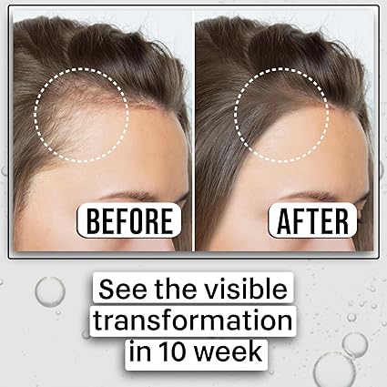 Advanced Hair Growth Serum for Men & Women – 3% Redensyl, 4% Anagain, Procapil & Lindera Extract – Fights Hair Fall, Stimulates Regrowth & Boosts Volume – 30ml