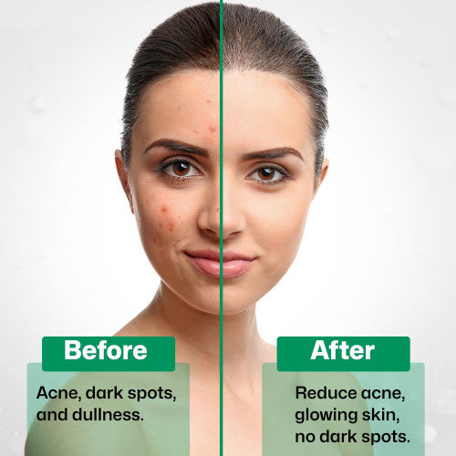 2% Salicylic Acid Face Serum for Acne, Blackheads & Oil Control – Deep Pore Cleansing for Oily Skin | For Men & Women (30ml)