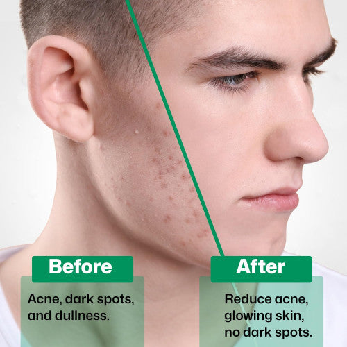 2% Salicylic Acid Face Serum for Acne, Blackheads & Oil Control – Deep Pore Cleansing for Oily Skin | For Men & Women (30ml)