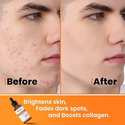 10% Vitamin C Face Serum with 0.5% Ferulic Acid & Hyaluronic Acid for Dark Spots, Hyperpigmentation & Brightening for Men & Women | 30 ml