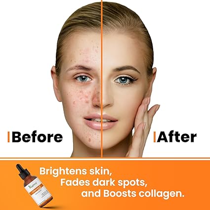 10% Vitamin C Face Serum with 0.5% Ferulic Acid & Hyaluronic Acid for Dark Spots, Hyperpigmentation & Brightening for Men & Women | 30 ml